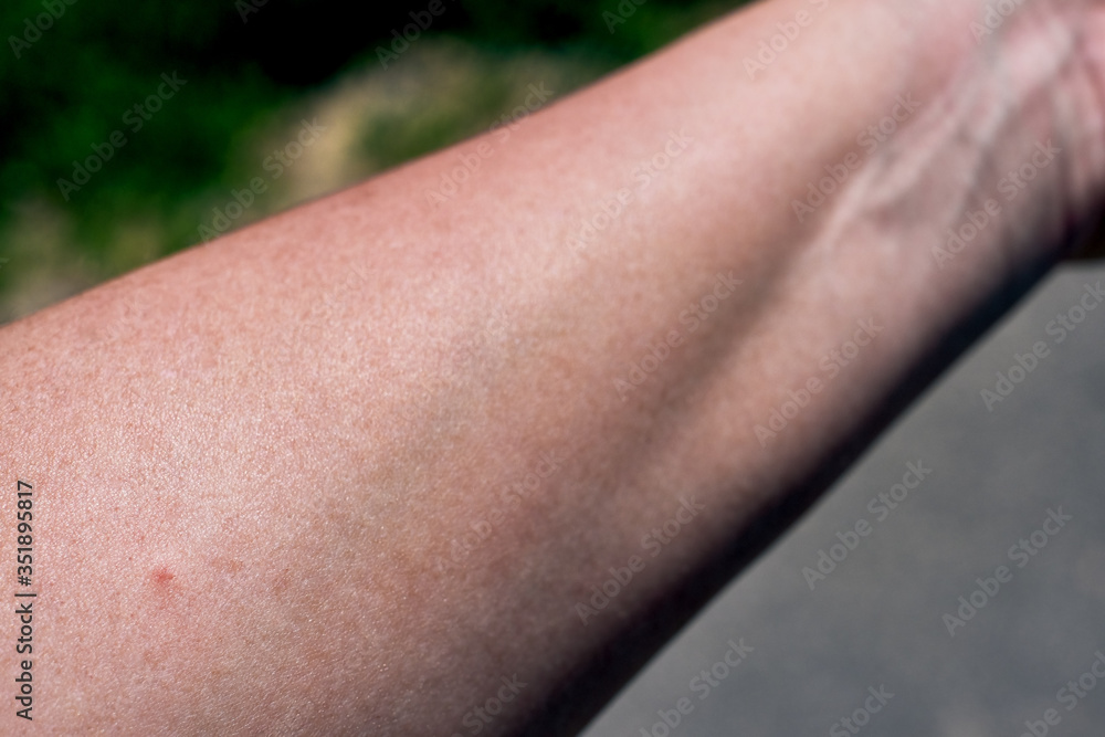 Tick bite on the arm of a woman. Little red dot, skin redness, wound and consequences right after the insect bite. Documented on a sunny spring day. Tick bite on the arm of a woman. Little red dot, skin redness, wound and consequences right after the insect bite. Documented on a sunny spring day.