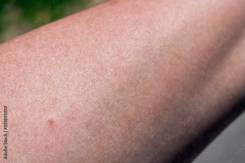 Fototapeta premium Tick bite on the arm of a woman. Little red dot, skin redness, wound and consequences right after the insect bite. Documented on a sunny spring day in Bavaria, Germany - Europe.