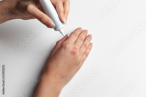 Girl puts ointment on her hand skin isolate on white background. Skin diseases  dermatitis  eczema  psoriasis  dry skin  cracked skin and redness. Place under the text.