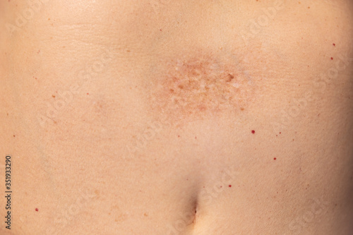 A port-wine stain or naevus flammeus being treated with laser therapy during childhood, which makes the reddish to purplish discolouration of the skin dissapear leaving small pigmented stains photo