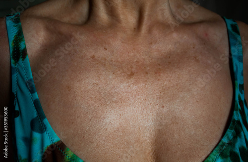 Piel del escote con arrugas y manchas por el foto envejecimiento prematuro de la piel por tomar el sol photo