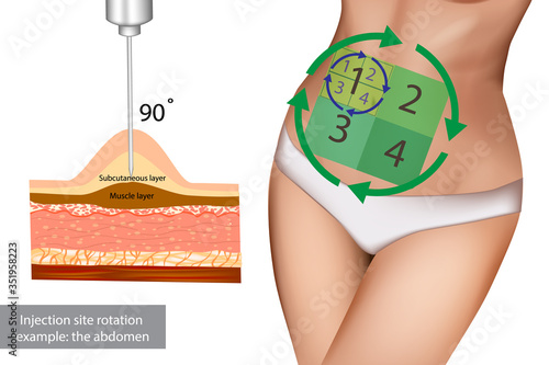 Injection sites for insulin injections. Injection site rotation example: the abdomen