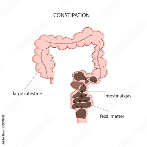 Fecal obstruction and gas accumulation in the colon. Medical poster constipation. Vector illustration