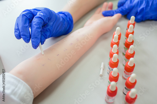 Skin Prick Allergy Testing for children photo