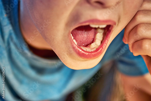 A child with an open mouth and misaligned teeth. Milk teeth in dentistry.