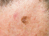 Lentigo maligna (melanoma in situ) on forehead of 64 year old male