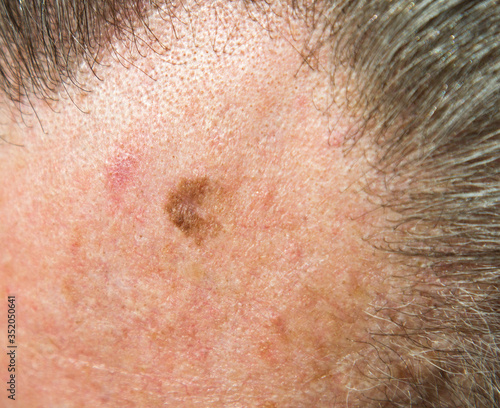 Lentigo maligna (melanoma in situ) on forehead of 64 year old male