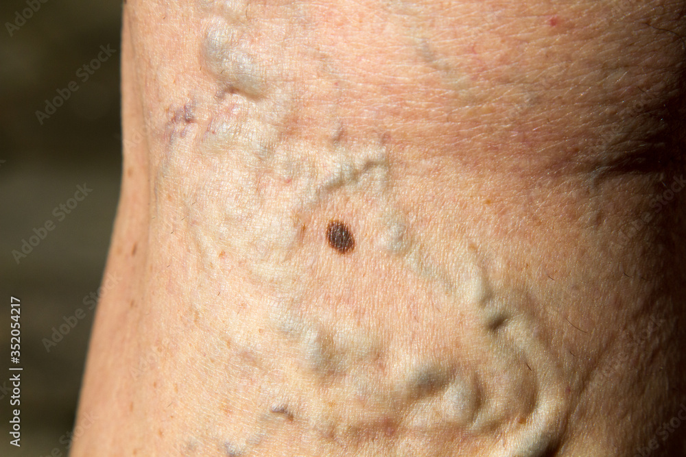 Naklejka premium Varicose veins on the back of the leg of 64 year old female.