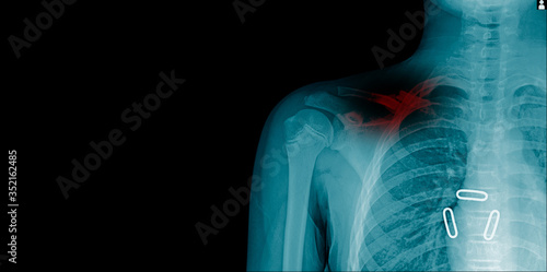 Obraz na płótnie fracture clavicle