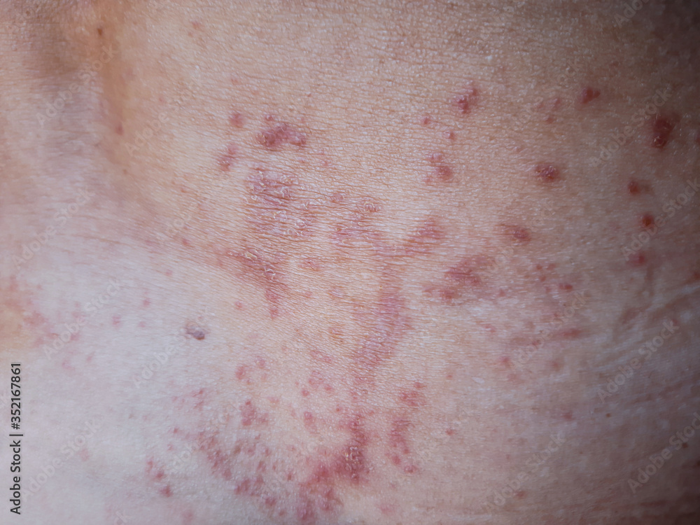 Skin disease prickly heat rash or miliaria on back skin of asian woman. Healthcare skin cause for outdoor work in sunny with hot weather and have sweat. Dermatologist and treatment medication concept. Skin disease prickly heat rash or miliaria on back skin of asian woman. Healthcare skin cause for outdoor work in sunny with hot weather and have sweat. Dermatologist and treatment medication concept.