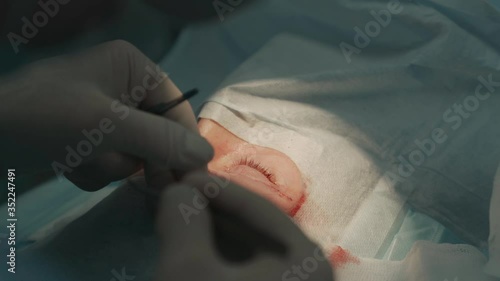 surgeon puts stitches on the patient's eye, upper blepharoplasty operation