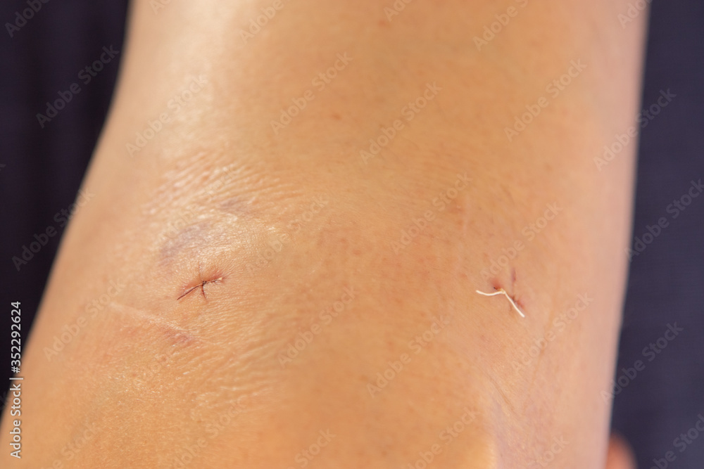 Fototapeta premium Post-surgery knee with stitches