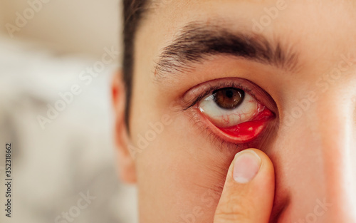 Infected sty barley purulent eye. Man pulls down lower eyelid showing inflammation pus caused by Staphylococcus.