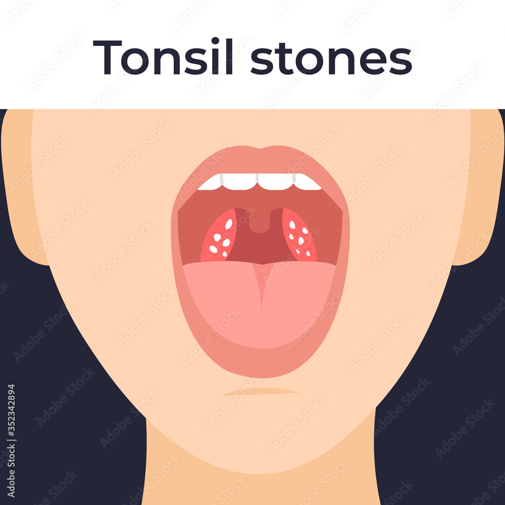 Tonsil stones in the throat, tonsilloliths. Flat vector cartoon