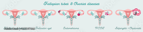 Women health - Fallopian tubes and Ovaries disorders - PCOS, endometrioma e.t.c. Gynecological diseases - Patient-friendly infographic. Uterus in flowers diagram - Isolated anatomical schemes