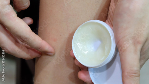 Fényképezés Hand holding a round ointment case, while the other hand trying to apply it to a mosquito bite