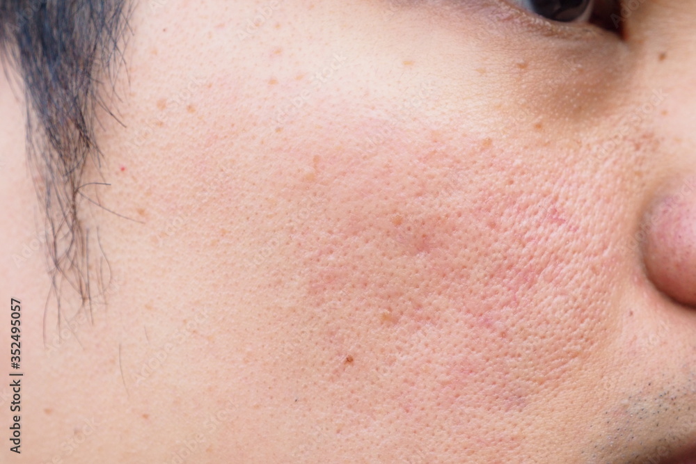 Closeup of red skin with acne moles and pores on the face of a young Asian man Closeup of red skin with acne moles and pores on the face of a young Asian man