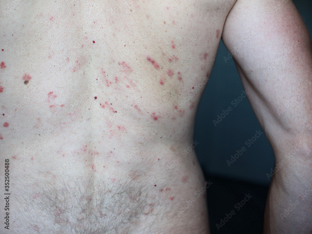 CLOSE UP: An unrecognized man suffering from an autoimmune incurable dermatological skin disease called psoriasis. Large red, inflamed rash all over the body. Stains of different sizes CLOSE UP: An unrecognized man suffering from an autoimmune incurable dermatological skin disease called psoriasis. Large red, inflamed rash all over the body. Stains of different sizes