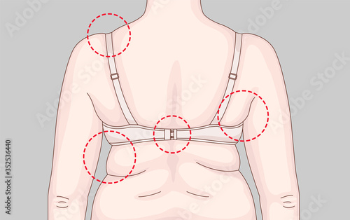 Overweight. Folds on the back. Wrong bra. Identification of problem areas on the back.