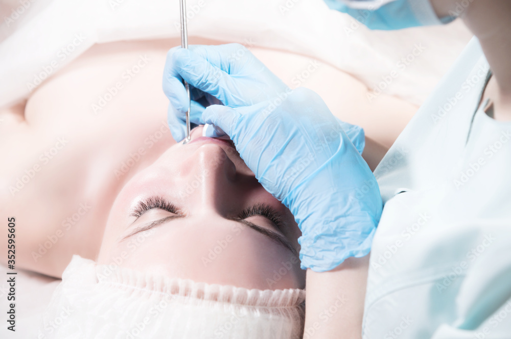 Fototapeta premium Close-up Mechanical face peel at the beautician. Beautician squeezes acne on the patient's forehead with a medical needle. Face next to hands in blue gloves of cosmologist