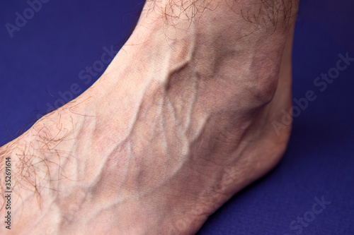 a man foot with a mesh of dilated varicose veins stands on a blue background