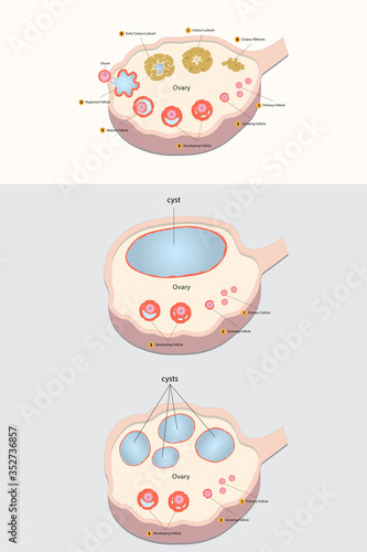 Normal ovary and ovarian cysts diagram vector design.