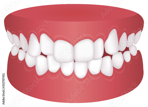 Teeth trouble ( bite type ) vector illustration /Crowding