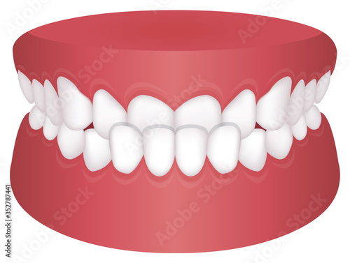 Teeth trouble ( bite type ) vector illustration /Underbite