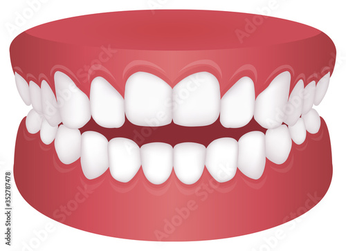 Teeth trouble ( bite type ) vector illustration  /Open bite