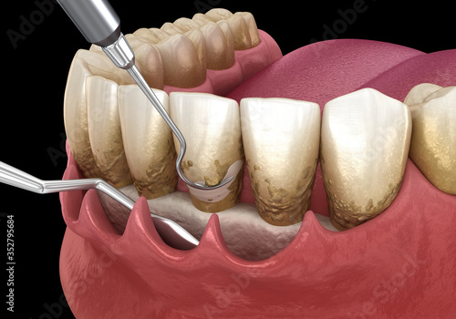 Open curettage: Scaling and root planing (conventional periodontal therapy). Medically accurate 3D illustration of human teeth treatment