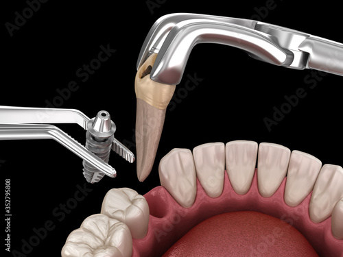 Fotografi Extraction and Implantation, complex immediate surgery