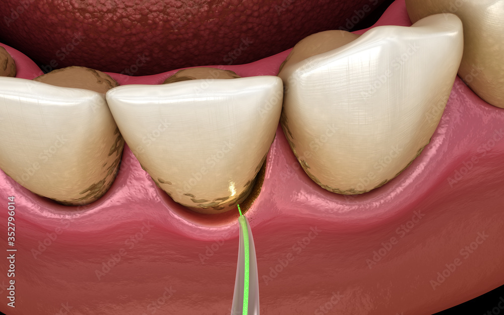 Laser removes a thin layer of infected skin, teeth cleaning. Medically accurate tooth 3D illustration - obrazy, fototapety, plakaty 