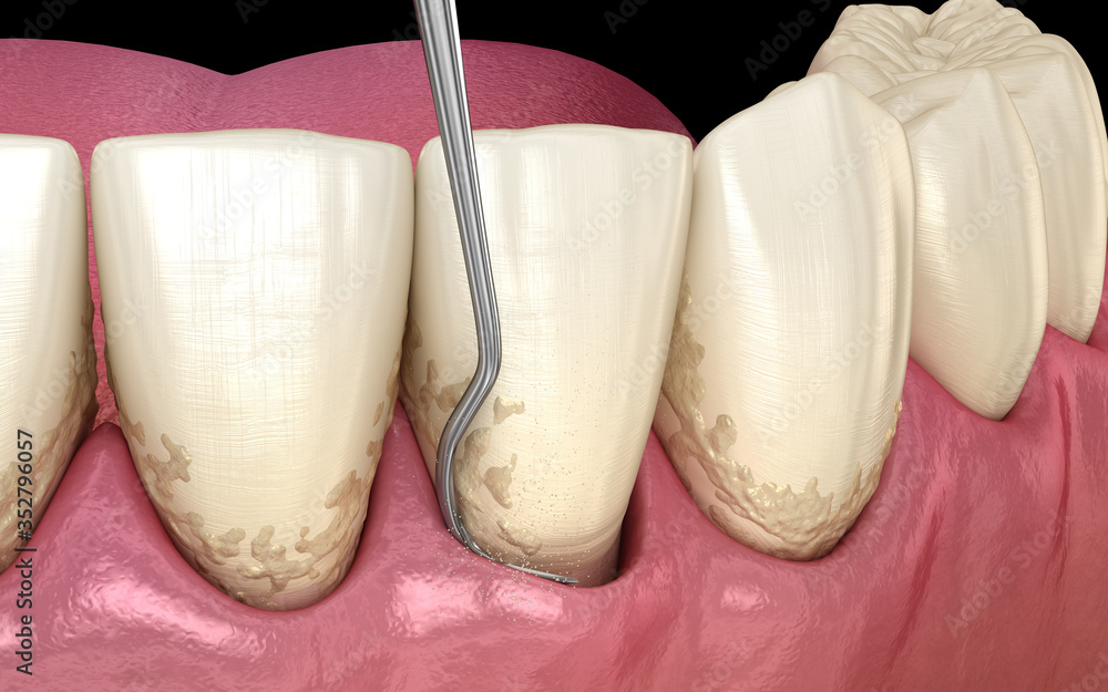 Closed curettage: Scaling and root planing (conventional periodontal therapy). Medically accurate 3D illustration of human teeth treatment - obrazy, fototapety, plakaty 