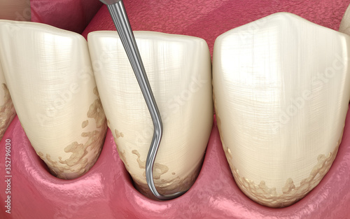 Closed curettage: Scaling and root planing (conventional periodontal therapy). Medically accurate 3D illustration of human teeth treatment