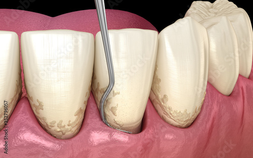 Closed curettage: Scaling and root planing (conventional periodontal therapy). Medically accurate 3D illustration of human teeth treatment photo