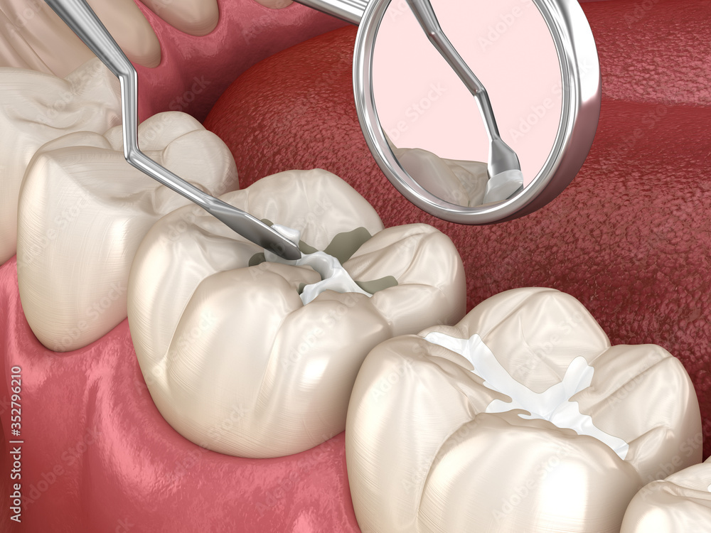 Molar tooth fissure restoration with filling. Medically accurate tooth 3D illustration. - obrazy, fototapety, plakaty 