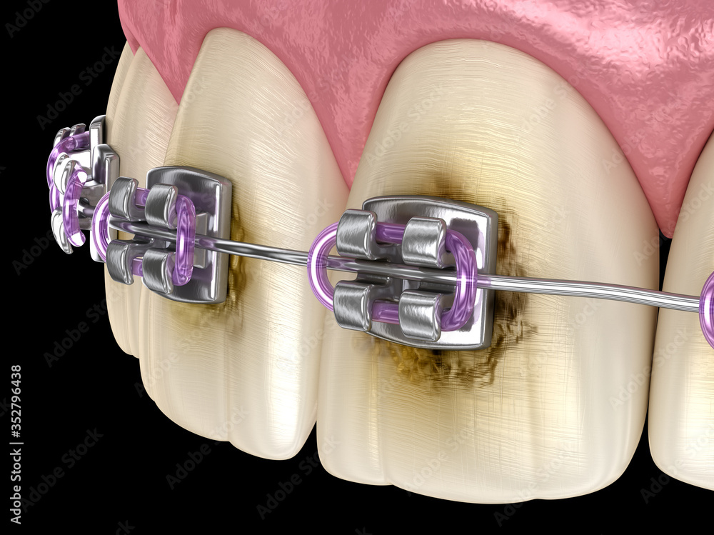Caries process near braces as result by poor hygiene. Medically accurate 3D illustration of oral hygiene. - obrazy, fototapety, plakaty 
