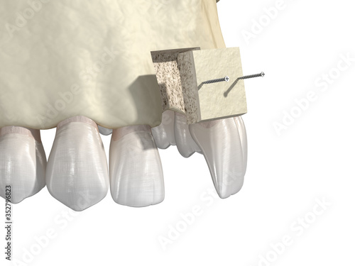 Bone grafting- augmentation using block of bone, tooth implantation. Medically accurate 3D illustration photo