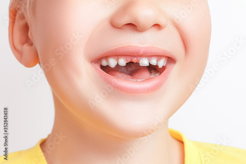 Happy smiling caucasian boy showing first dropped milk tooth. Closeup of open mouth without a tooth.