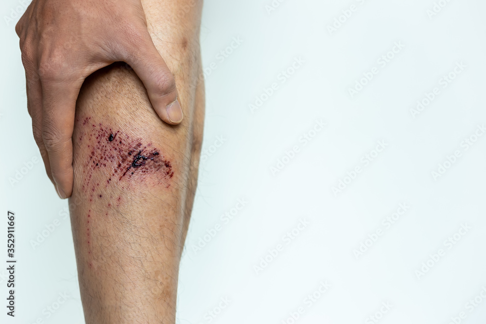 Fototapeta premium Red Wound injury on man leg with scabs, abrasion. Wound happen during young man working and fall down on the floor. He get injured at shin It is big wound. He get painful, touch wound. copy space
