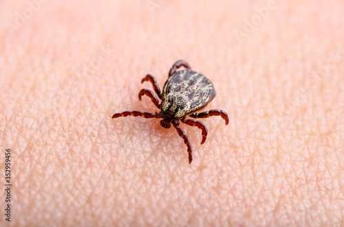 Lyme Disease Infected Tick Mite Insect Crawling on Skin. Encephalitis Virus or Lyme Borreliosis Infectious Dermacentor Tick Arachnid Parasite Close-up © nechaevkon