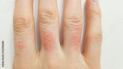A hand with dermatological problems. Redness, dry irritation on the skin of the hands. Allergic reaction to chemicals. Disease
