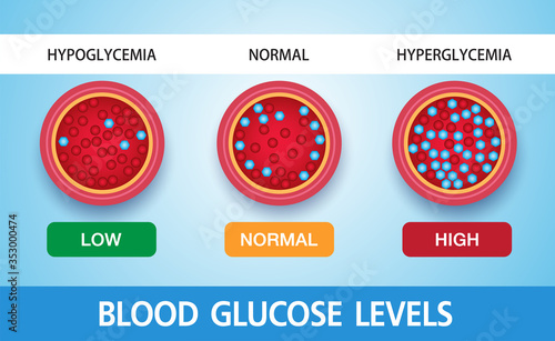 Hyperglycemia, High Blood Sugar and Diabetes ,obesity is a serious medical condition causes, vector design.