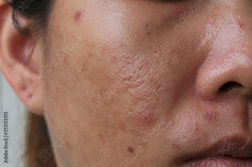 Large pore and blemish Asian skin