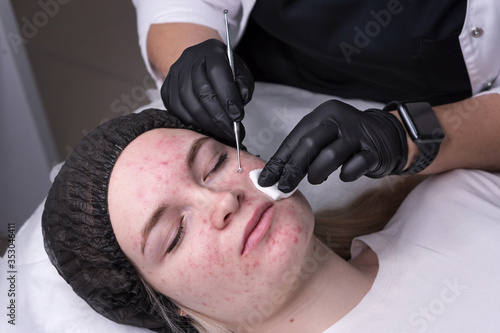 Procedure mechanical face cleaning in beauty salon. Young model getting cosmetic face skin care and treatments in cosmetologist. Acne treatment. Spa, cosmetology and wellness relaxation concept.