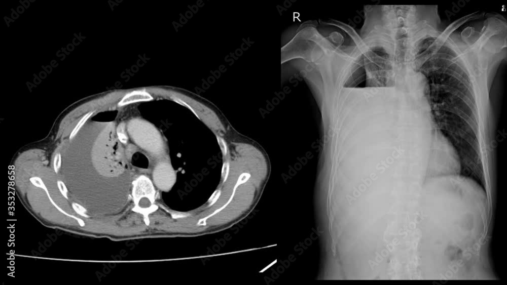 Chest xray Two views Severe right pleural effusion with