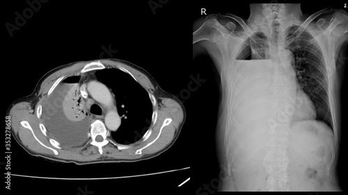 Chest x-ray Two views Severe right pleural effusion with hydropneumothorax. Compressive atelectasis of right lung photo