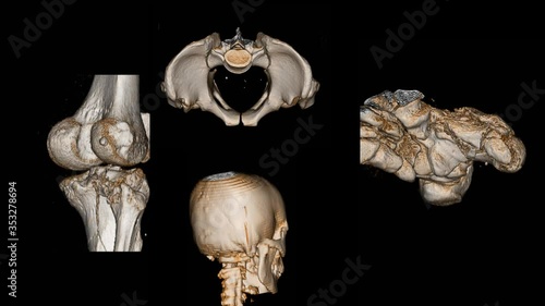 CT scan  3D render of Knee joint,Pelvis,Skull and Foot Medical footage concept.