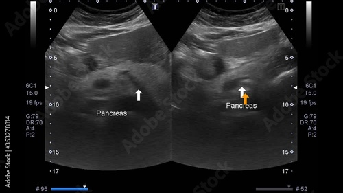 Blurry Ultrasound Whole : Abdomen Showing laarge gastric tumor of body and antrum with luminal narrowing of gastic antrum.Liver,GB,CBD,pancreas,spleen and both kidneys are normal.