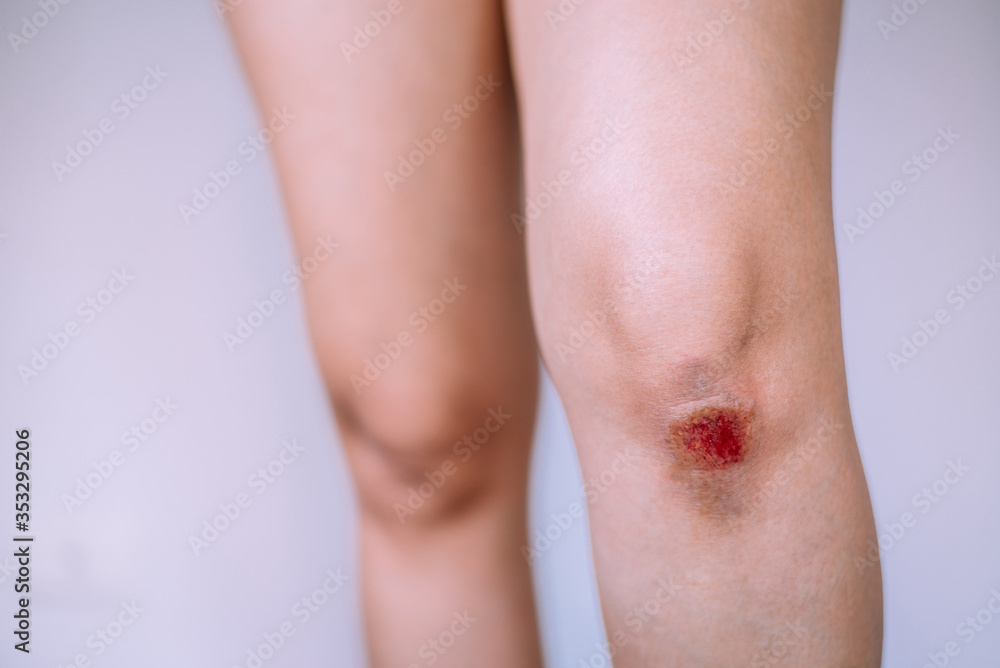 Woman suffering from bleeding wound on her knee on white blackground,Scab becomes Infected Woman suffering from bleeding wound on her knee on white blackground,Scab becomes Infected
